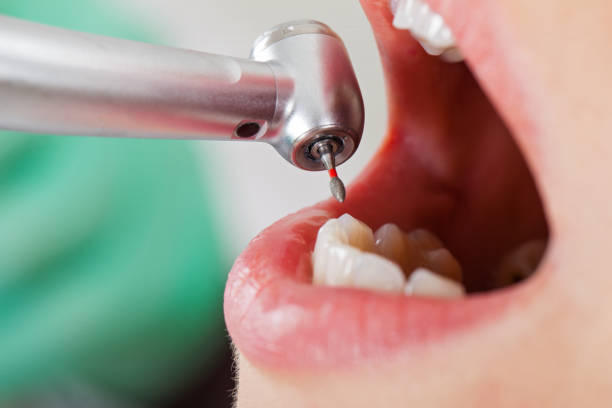 Best Emergency Tooth Extraction in Dassel, MN